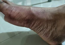 Kenali Empat Jenis Patah Tulang