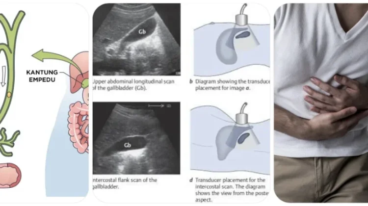 Pahami Faktor Resiko Batu Empedu pada Usia Muda