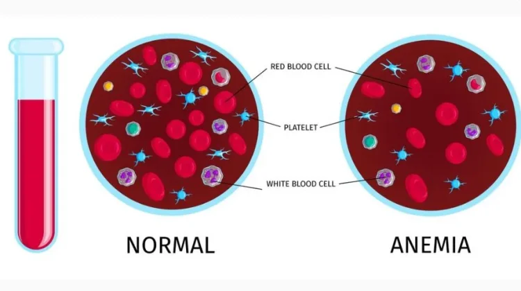 Jangan Sepelekan Anemia, Waspada Faktor Resiko Gangguan Jantung dan Ginjal