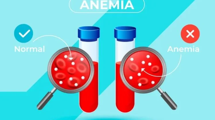 Alami Anemia, Makanan Ini Wajib Dikonsumsi