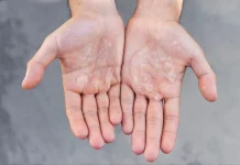 Kulit Tangan Kering, Lalukan Cara Ini