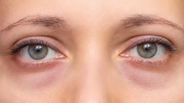Cara Mengurangi Mata Panda tanpa Makeup, Ini Tipsnya
