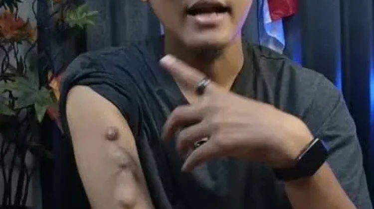 Benjolan pada Lengan Pasien Cuci Darah, Waspadai Masalah pada Akses Hemodialisis