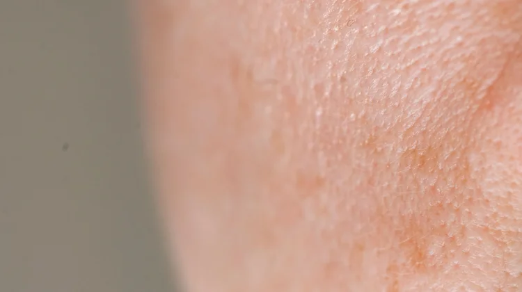 Kenali Tanda Skin Barrier Mulai Rusak