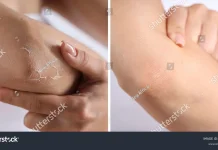 Siku Kering dan Gatal? Ini Penyebabnya!