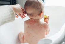 Cuaca Panas Bisa Perparah Eksim pada Bayi