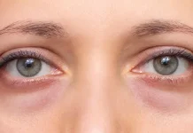 Cara Mengurangi Mata Panda tanpa Makeup, Ini Tipsnya