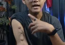 Benjolan pada Lengan Pasien Cuci Darah, Waspadai Masalah pada Akses Hemodialisis