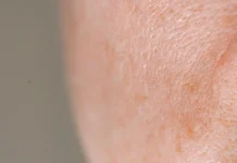 Kenali Tanda Skin Barrier Mulai Rusak