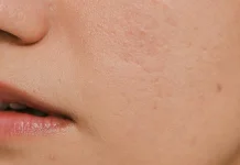 Skin Barrier Melemah? Ini Cara Sederhana Menjaga Kesehatan Kulit