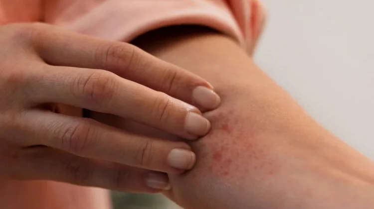 Penyebab Dermatographia Dipicu Berbagai Faktor, Salah Satunya Gesekan pada Kulit