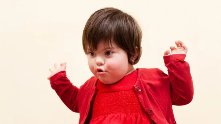 Kenali Gejala Down Syndrome sejak Dini pada Anak