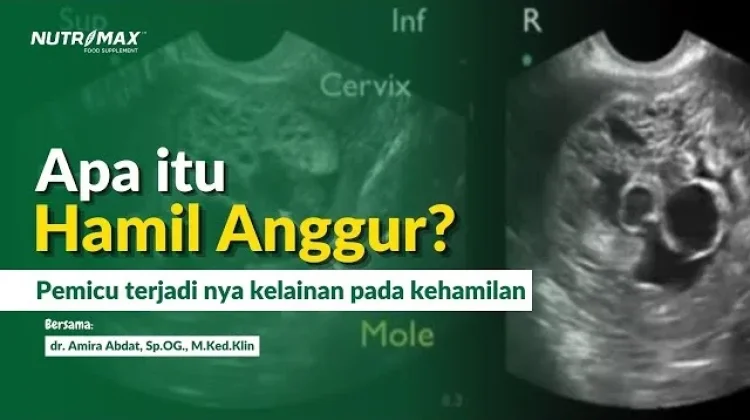 Mengenal apa itu Hamil Anggur