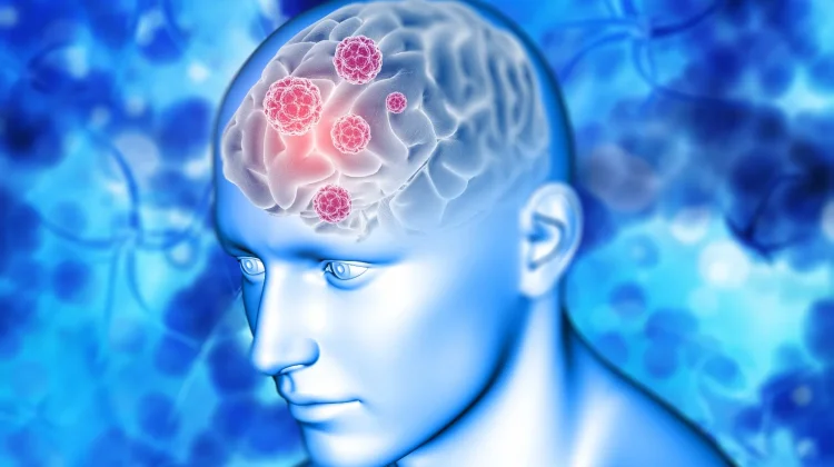 Hari Tumor Otak Sedunia, Momentum Peningkatan Kesadaran Kesehatan