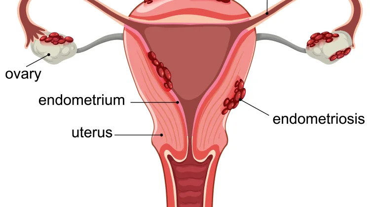 Berikut Faktor yang Diduga Berperan Penyebab Endometriosis