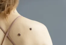 Mengenal Gejala Dermatofibroma, Benjolan Kulit yang Umumnya Jinak