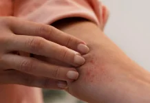 Penyebab Dermatographia Dipicu Berbagai Faktor, Salah Satunya Gesekan pada Kulit