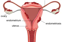 Berikut Faktor yang Diduga Berperan Penyebab Endometriosis