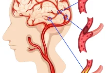 Berbagai Faktor Pemicu Ensefalopati, dari Cedera Kepala hingga Kanker