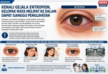 Kenali Gejala Entropion, Kelopak Mata Melipat ke dalam Dapat Ganggu Penglihatan
