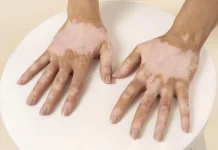 Hari Vitiligo Sedunia Tingkatkan Kesadaran dan Dukungan Global