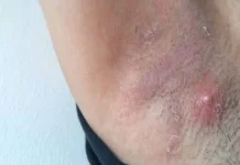 Waspadai Penyakit pada Ketiak, Kenali Penyebab dan Cara Pencegahannya