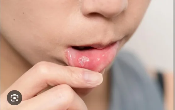 Cegah Sariawan agar Puasa Tetap Nyaman