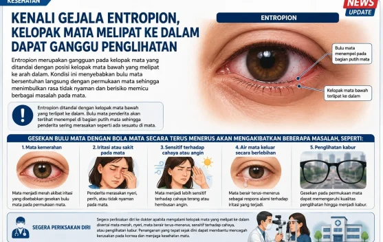 Kenali Gejala Entropion, Kelopak Mata Melipat ke dalam Dapat Ganggu Penglihatan