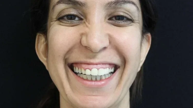 Mengenali Istilah Gummy Smile