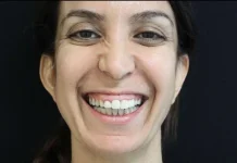 Mengenali Istilah Gummy Smile