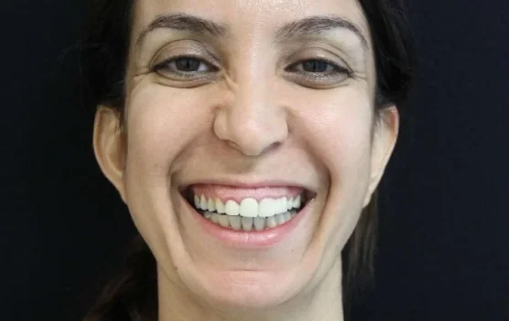 Mengenali Istilah Gummy Smile