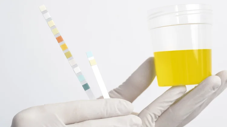 Benarkah Warna Urine Menentukan Kondisi Kesehatan Ginjal?