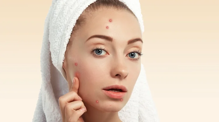 Mengenal Perbedaan Stiker Jerawat dan Obat Totol Jerawat