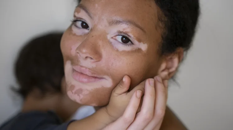 Mengenal Perbedaan Vitiligo dan Albino