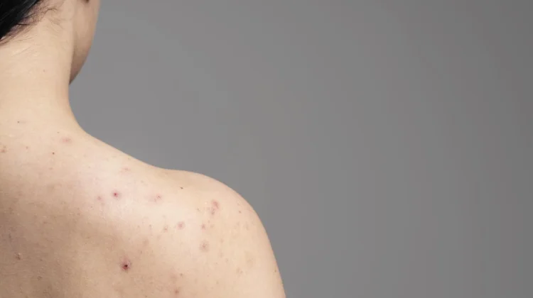 Mengenal Hidradenitis Suppurativa dan Penyebabnya