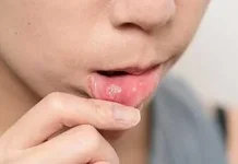 Waspada Kena Seriawan saat Puasa