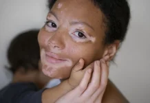 Mengenal Perbedaan Vitiligo dan Albino