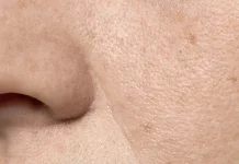 Mengenal Strawberry Skin dan Penyebabnya