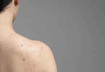 Mengenal Hidradenitis Suppurativa dan Penyebabnya