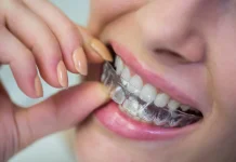 Perbedaan Aligner dan Behel untuk Merapikan Gigi