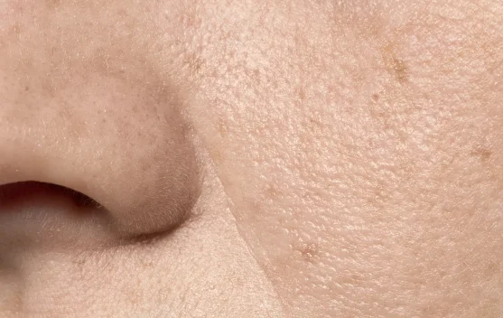Mengenal Strawberry Skin dan Penyebabnya