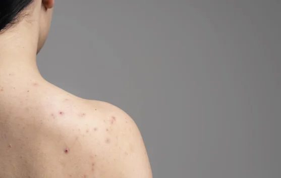 Mengenal Hidradenitis Suppurativa dan Penyebabnya