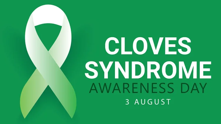 Mengenal Sindrom CLOVES, Edukasi Penyakit Langka sejak Dini
