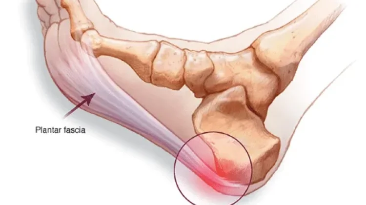 Apa itu Plantar Fasciitis ?