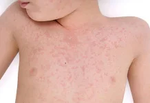 Campak, Penyakit yang Cepat Menular