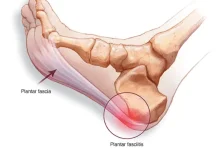 Apa itu Plantar Fasciitis ?