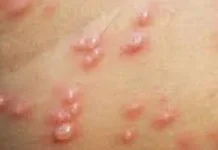 Cacar Air, Penyakit Kulit yang Cepat Menular