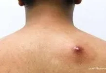Pahami Penyebab Terjadinya Bisul