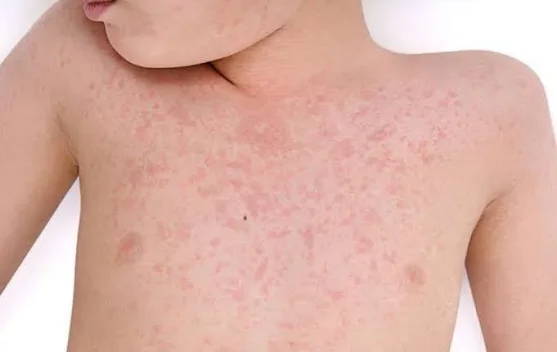 Campak, Penyakit yang Cepat Menular