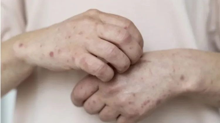 Indonesia Responds to Measles Case Involves Travel from Indonesia to Australia